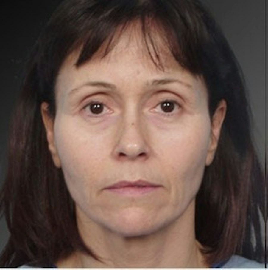 Patient 106009232 | Front View | Before | Face and Neck Lift — Steven Teitelbaum MD -