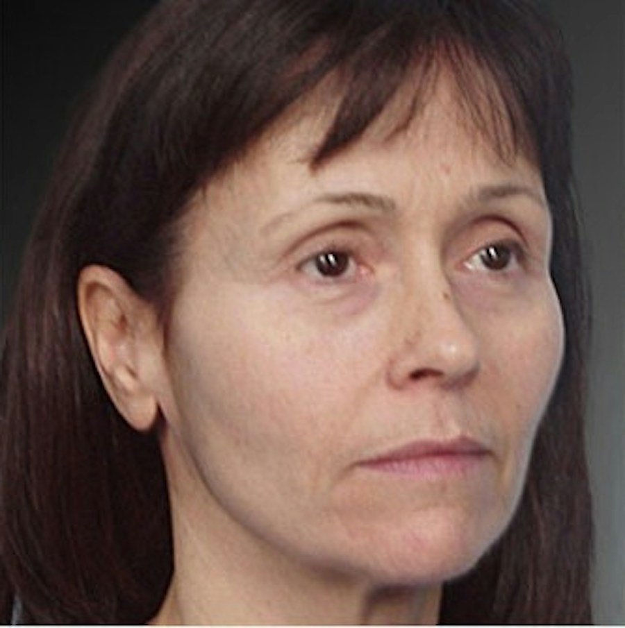 Patient 106009232 | Angle View | Before | Face and Neck Lift — Steven Teitelbaum MD -