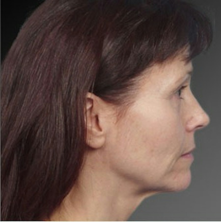 Patient 106009232 | Profile View | Before | Face and Neck Lift — Steven Teitelbaum MD -