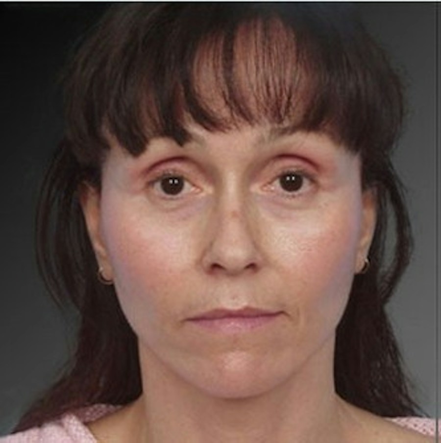 Patient 106009232 | Front View | After | Face and Neck Lift — Steven Teitelbaum MD -