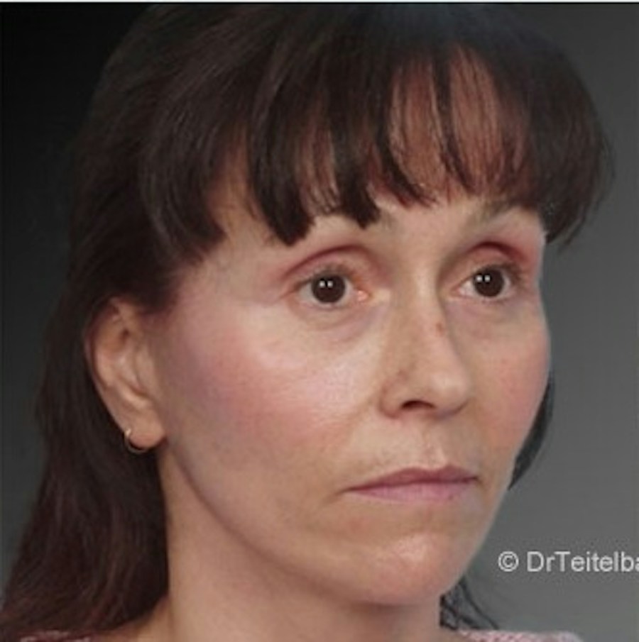 Patient 106009232 | Angle View | After | Face and Neck Lift — Steven Teitelbaum MD -
