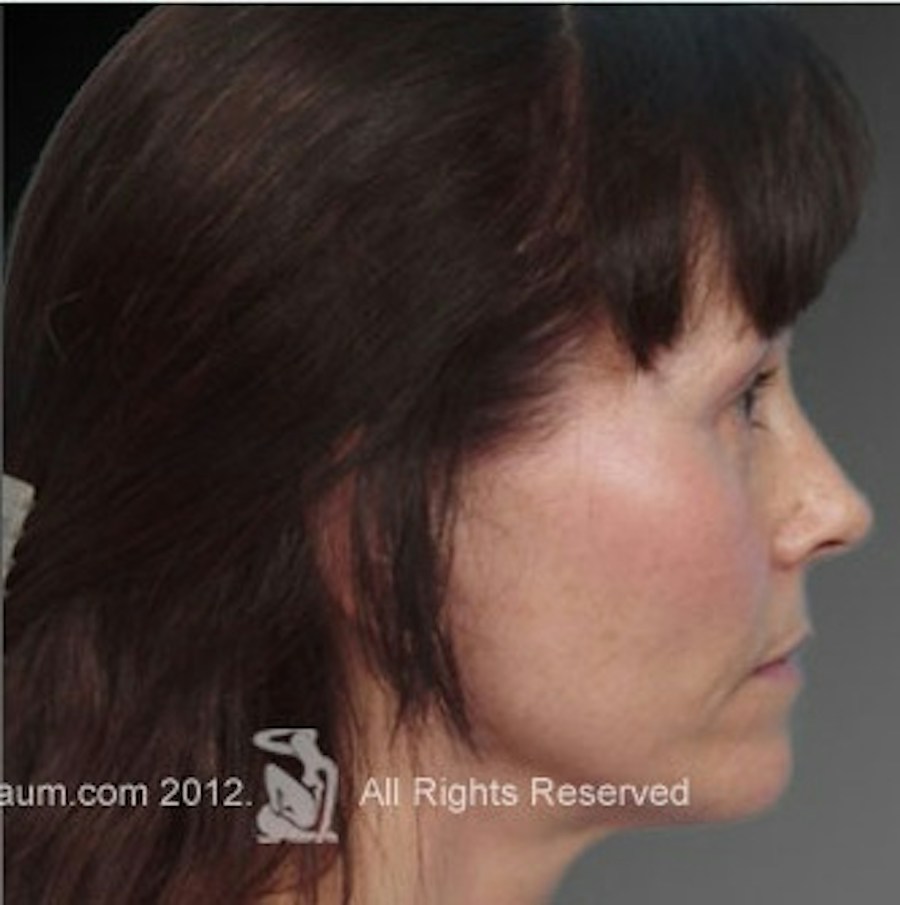 Patient 106009232 | Profile View | After | Face and Neck Lift — Steven Teitelbaum MD -