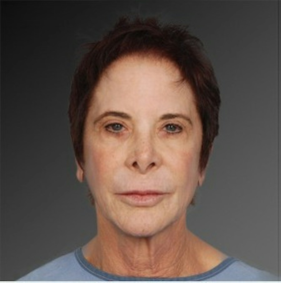 Patient 106009233 | Front View | Before | Face and Neck Lift — Steven Teitelbaum MD -
