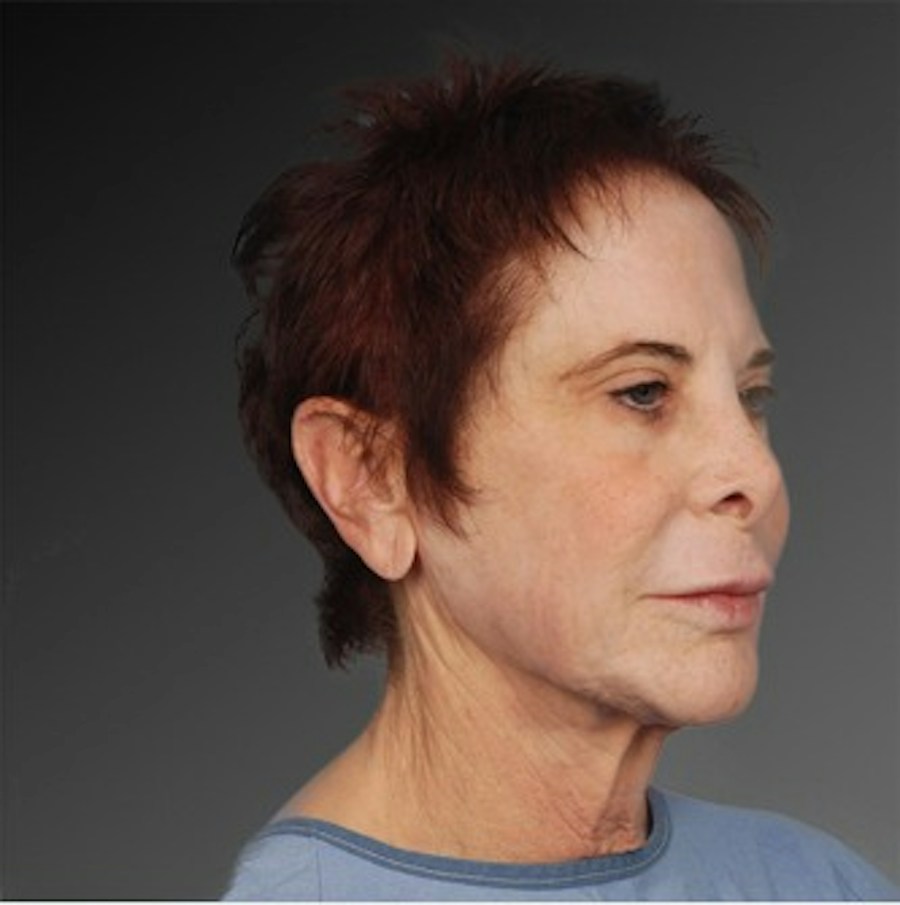 Patient 106009233 | Angle View | Before | Face and Neck Lift — Steven Teitelbaum MD -