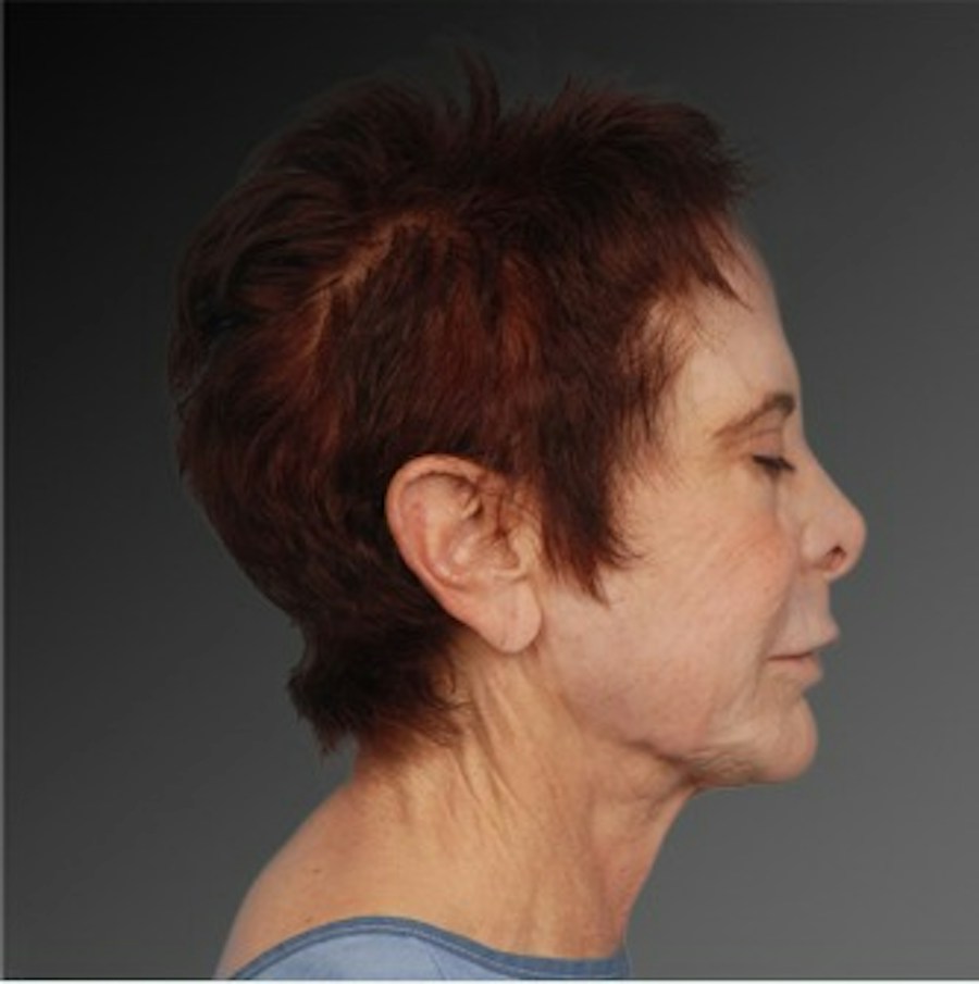 Patient 106009233 | Profile View | Before | Face and Neck Lift — Steven Teitelbaum MD -