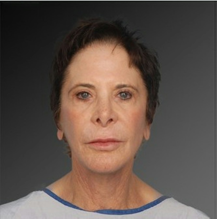 Patient 106009233 | Front View | After | Face and Neck Lift — Steven Teitelbaum MD -