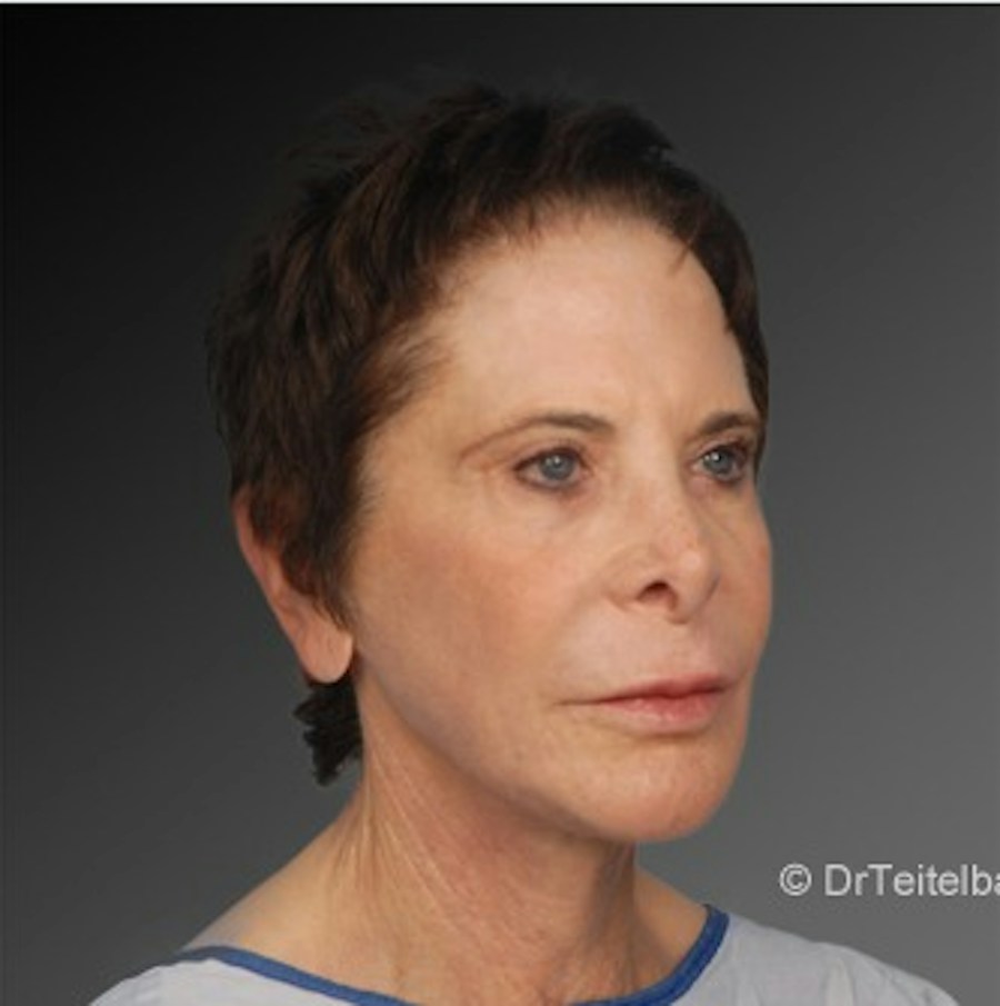 Patient 106009233 | Angle View | After | Face and Neck Lift — Steven Teitelbaum MD -