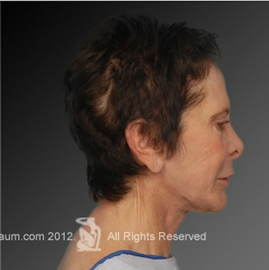 Patient 106009233 | Profile View | After | Face and Neck Lift — Steven Teitelbaum MD -