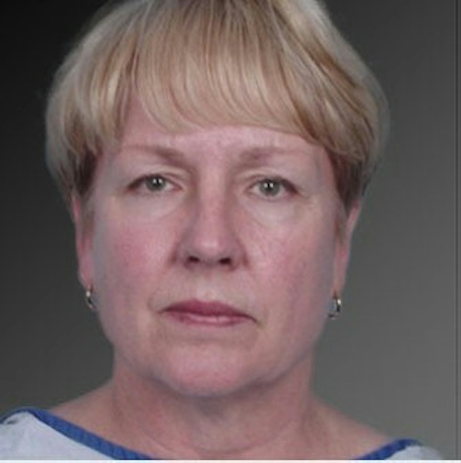 Patient 106009234 | Front View | Before | Face and Neck Lift — Steven Teitelbaum MD -