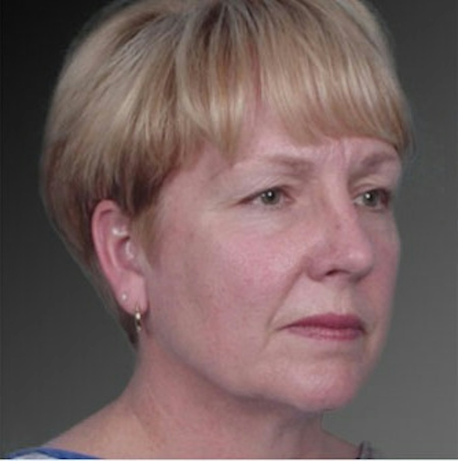 Patient 106009234 | Angle View | Before | Face and Neck Lift — Steven Teitelbaum MD -