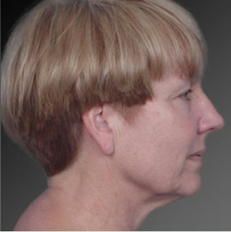 Patient 106009234 | Profile View | Before | Face and Neck Lift — Steven Teitelbaum MD -