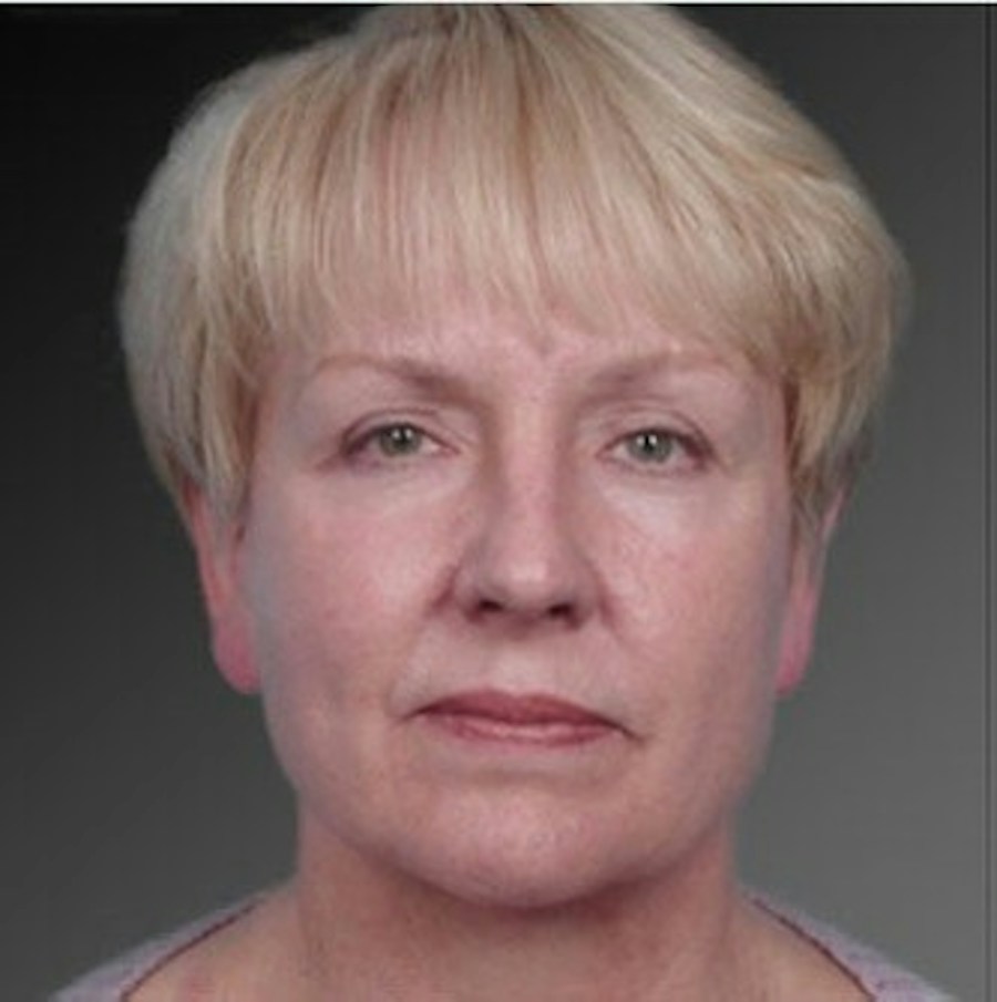 Patient 106009234 | Front View | After | Face and Neck Lift — Steven Teitelbaum MD -