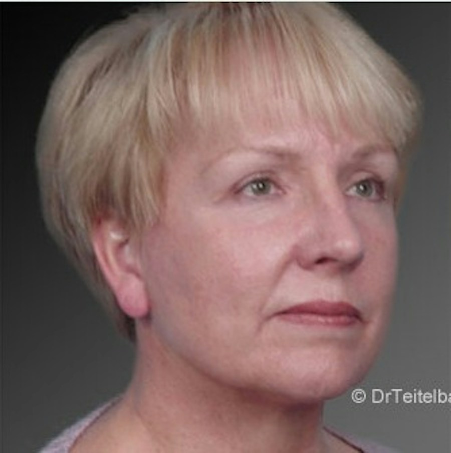 Patient 106009234 | Angle View | After | Face and Neck Lift — Steven Teitelbaum MD -