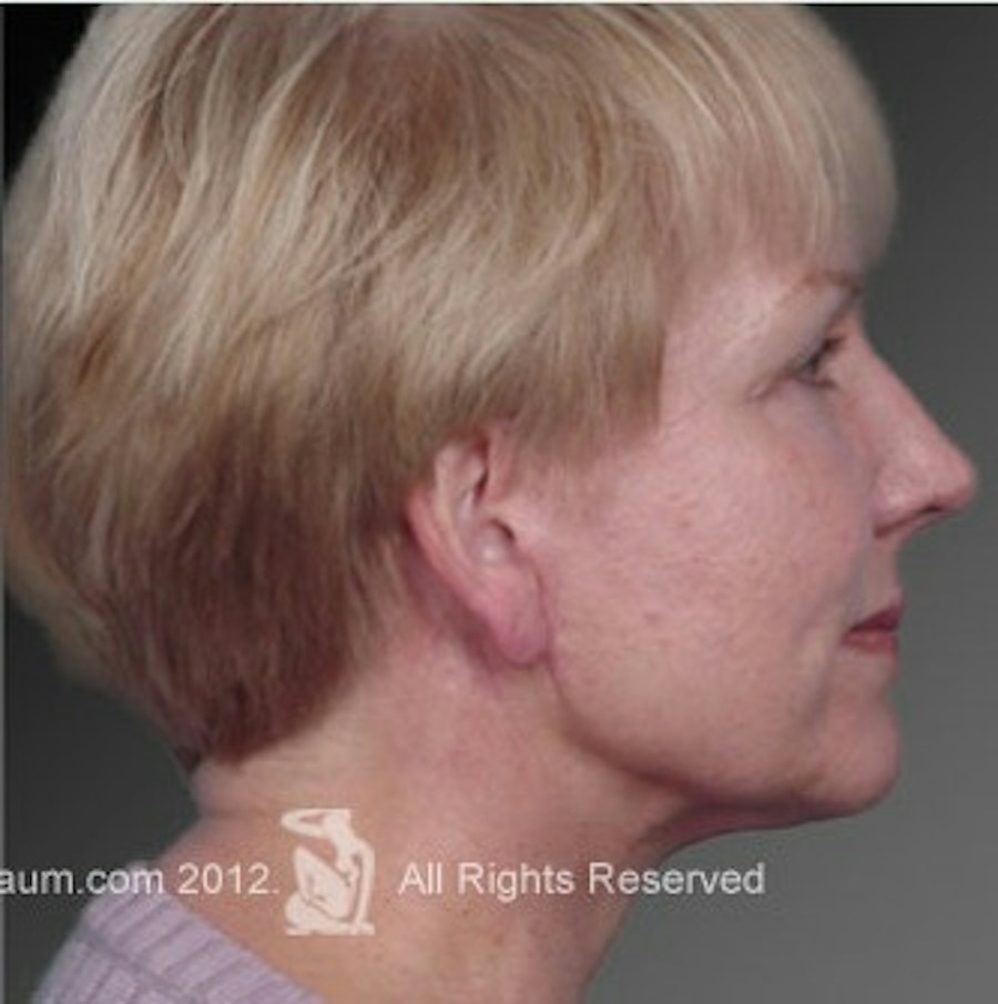 Patient 106009234 | Profile View | After | Face and Neck Lift — Steven Teitelbaum MD -