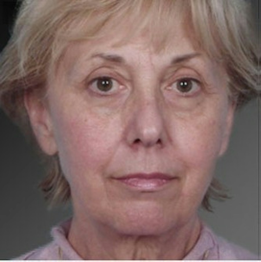 Patient 106009235 | Front View | Before | Face and Neck Lift — Steven Teitelbaum MD -
