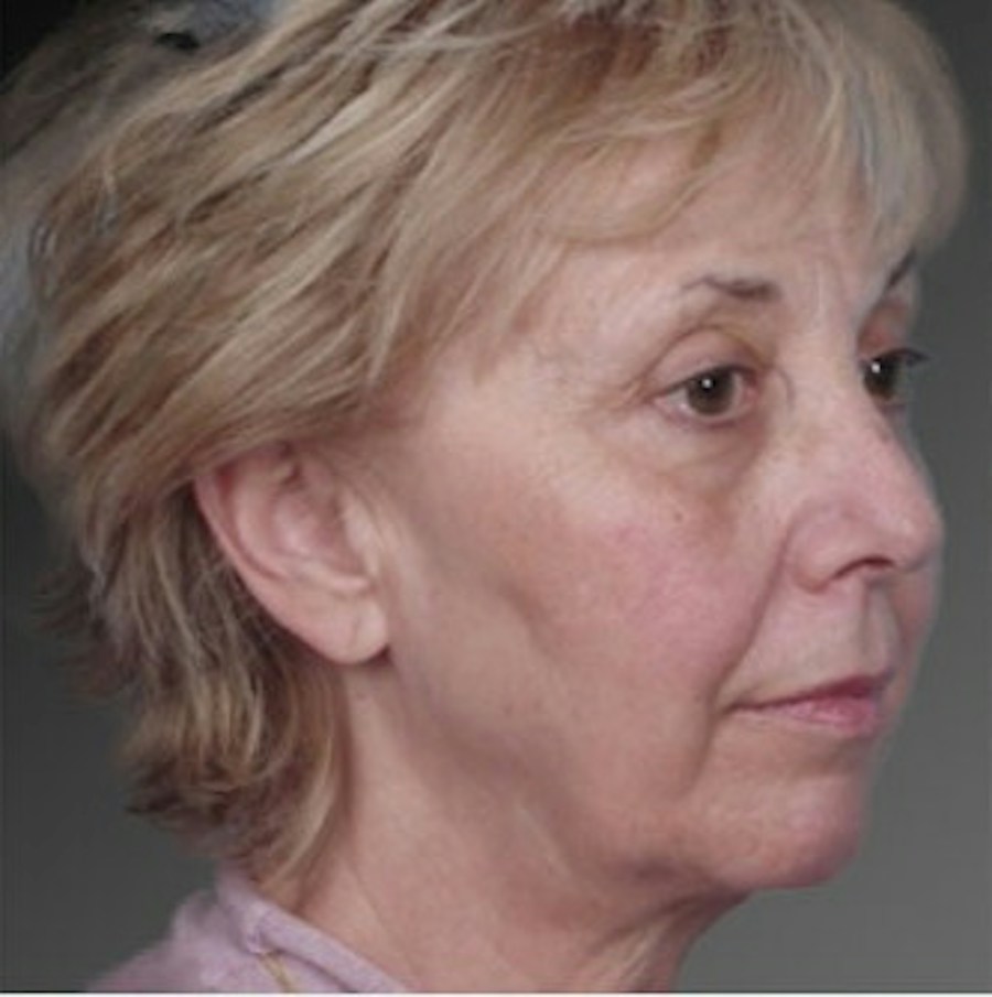 Patient 106009235 | Angle View | Before | Face and Neck Lift — Steven Teitelbaum MD -