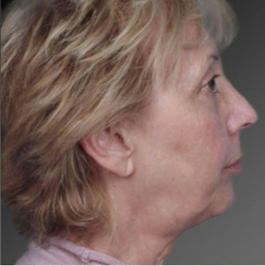 Patient 106009235 | Profile View | Before | Face and Neck Lift — Steven Teitelbaum MD -