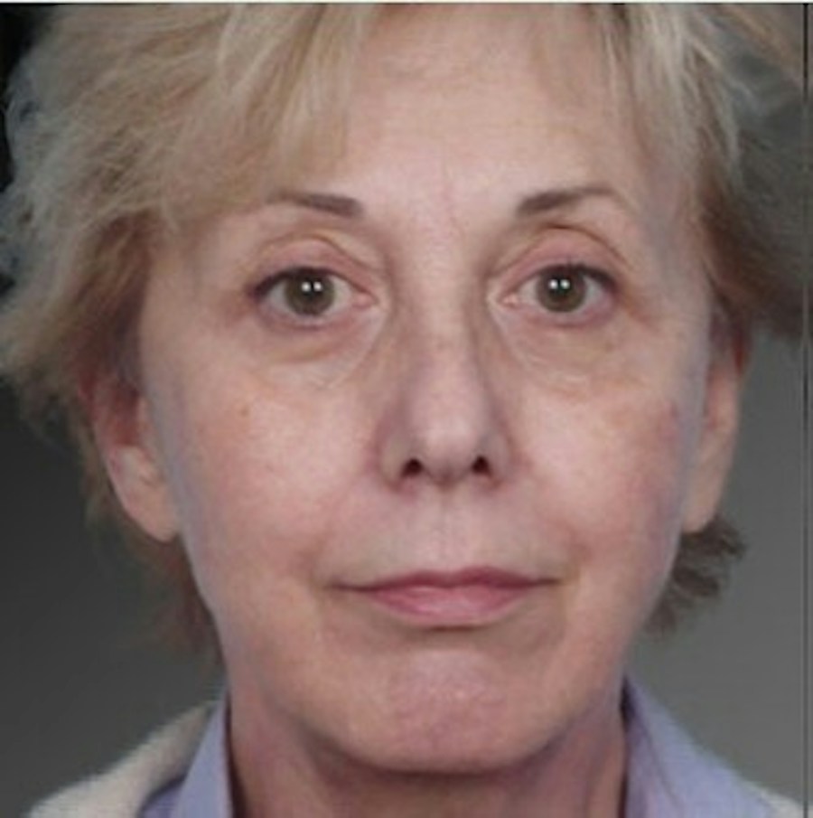 Patient 106009235 | Front View | After | Face and Neck Lift — Steven Teitelbaum MD -