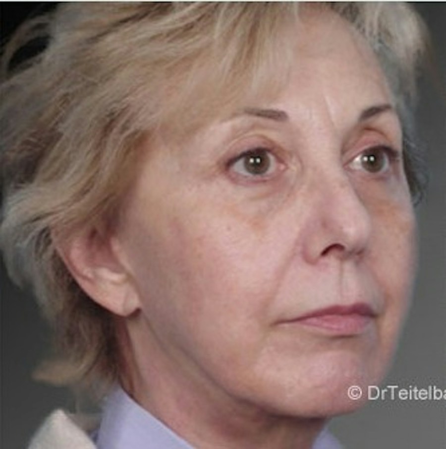 Patient 106009235 | Angle View | After | Face and Neck Lift — Steven Teitelbaum MD -