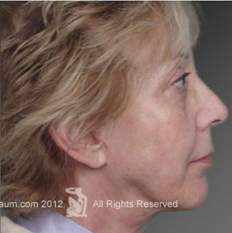 Patient 106009235 | Profile View | After | Face and Neck Lift — Steven Teitelbaum MD -