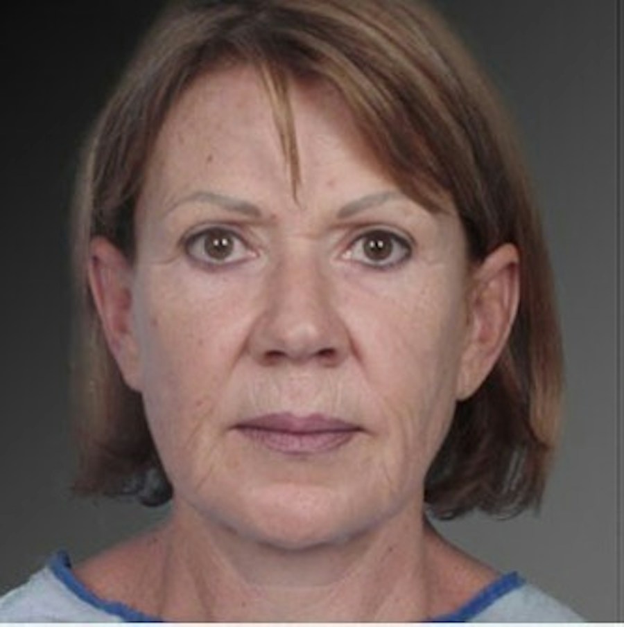Patient 106009237 | Front View | Before | Face and Neck Lift — Steven Teitelbaum MD -