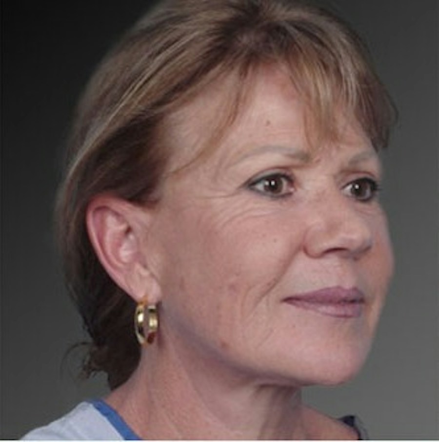 Patient 106009237 | Angle View | Before | Face and Neck Lift — Steven Teitelbaum MD -