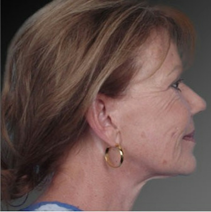 Patient 106009237 | Profile View | Before | Face and Neck Lift — Steven Teitelbaum MD -