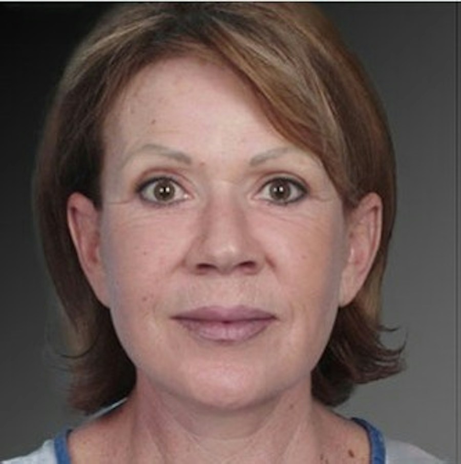 Patient 106009237 | Front View | After | Face and Neck Lift — Steven Teitelbaum MD -