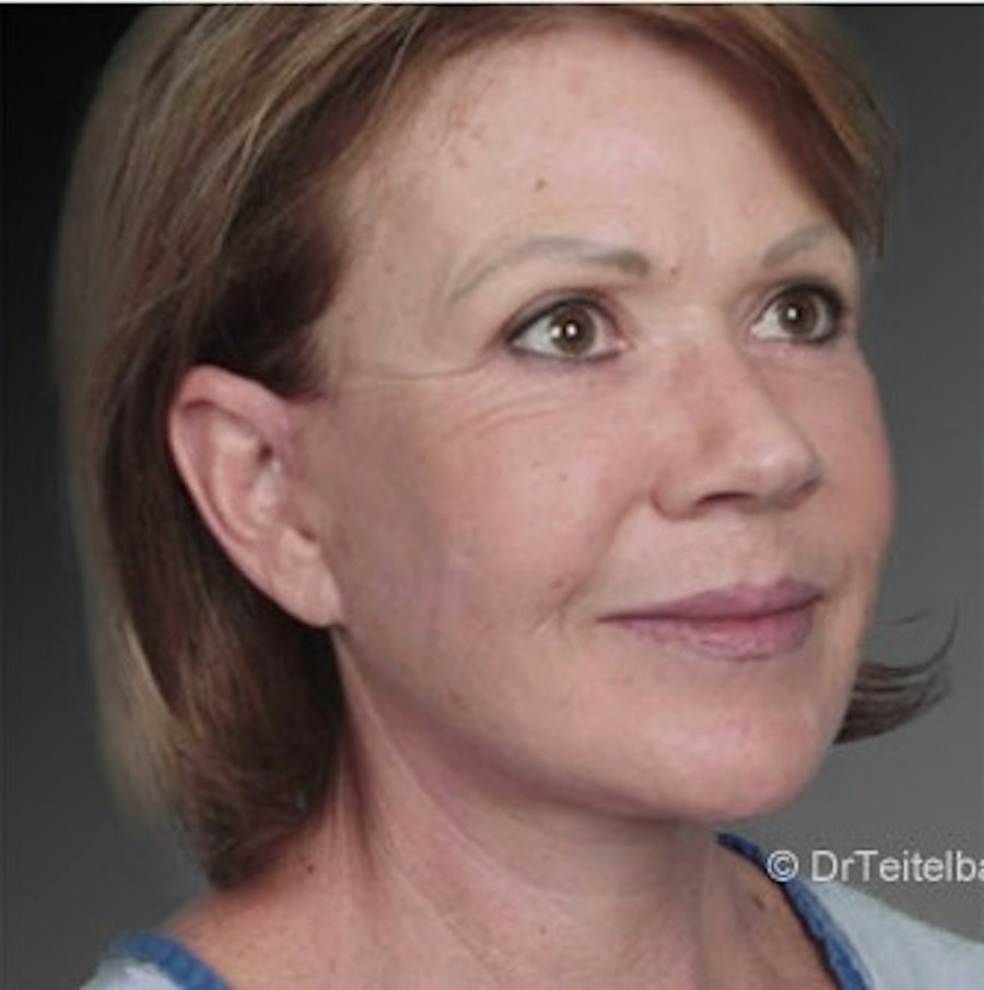 Patient 106009237 | Angle View | After | Face and Neck Lift — Steven Teitelbaum MD -