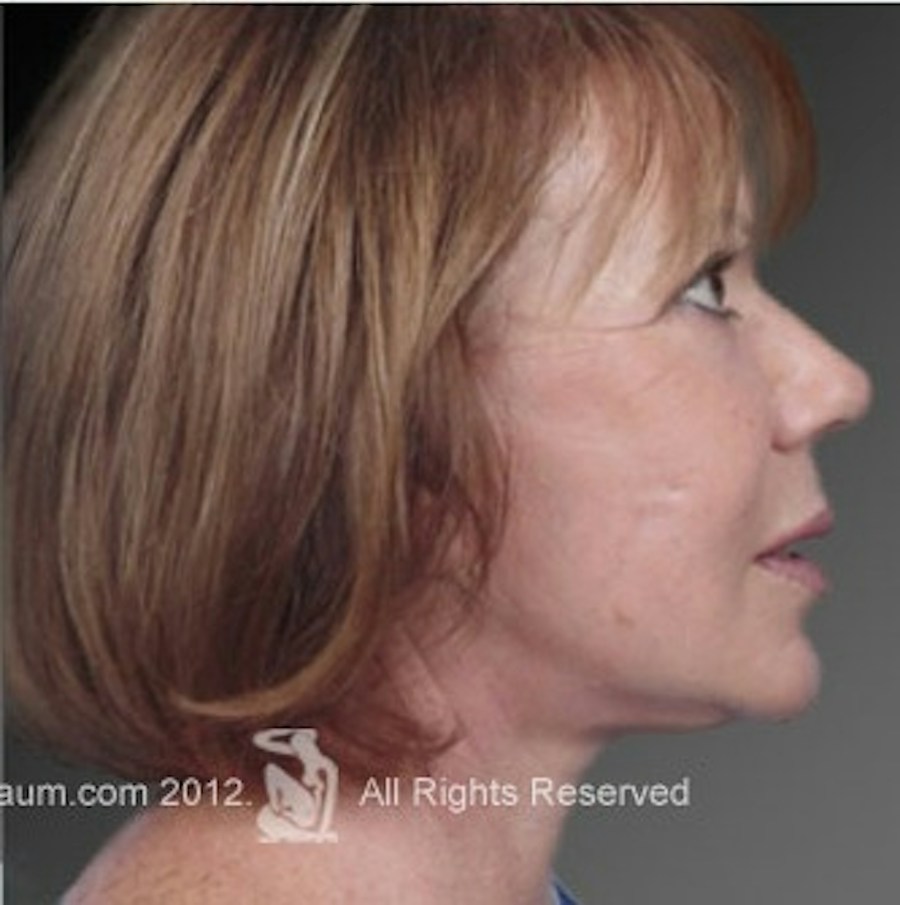 Patient 106009237 | Profile View | After | Face and Neck Lift — Steven Teitelbaum MD -