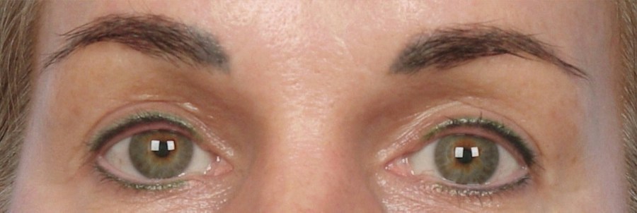 Patient 106009242 | Front View | After | Eyelift — Steven Teitelbaum MD - Santa Monica