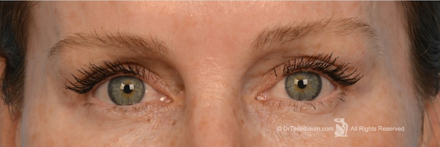 Patient 106009243 | Front View | After | Eyelift — Steven Teitelbaum MD - Santa Monica