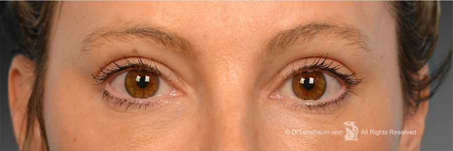 Patient 106009247 | Front View | After | Eyelift — Steven Teitelbaum MD - Santa Monica