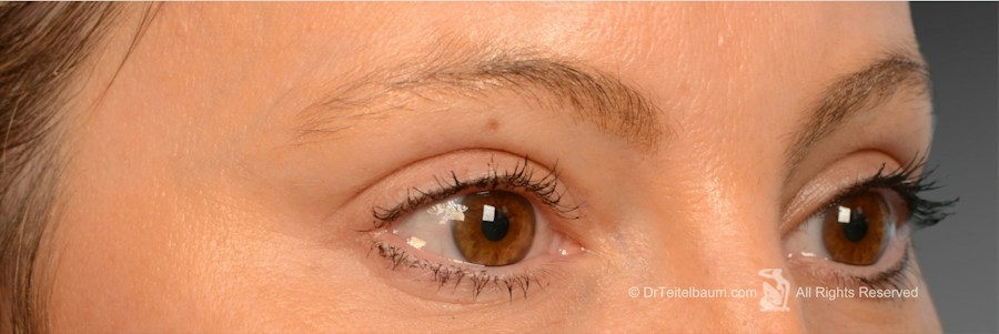 Patient 106009248 | Front View | After | Eyelift — Steven Teitelbaum MD - Santa Monica