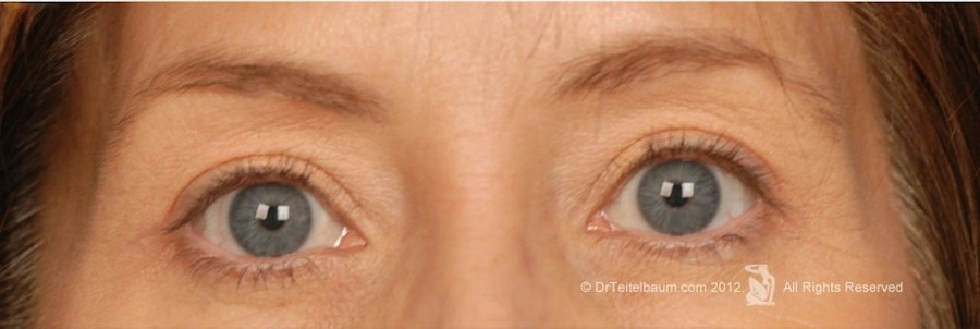 Patient 106009252 | Front View | After | Eyelift — Steven Teitelbaum MD - Santa Monica