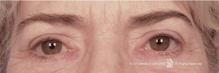 Patient 194149 | Front View | After | Brow Lift — Steven Teitelbaum MD - Santa Monica