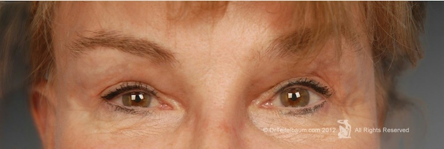 Patient 255815 | Front View | After | Brow Lift — Steven Teitelbaum MD - Santa Monica