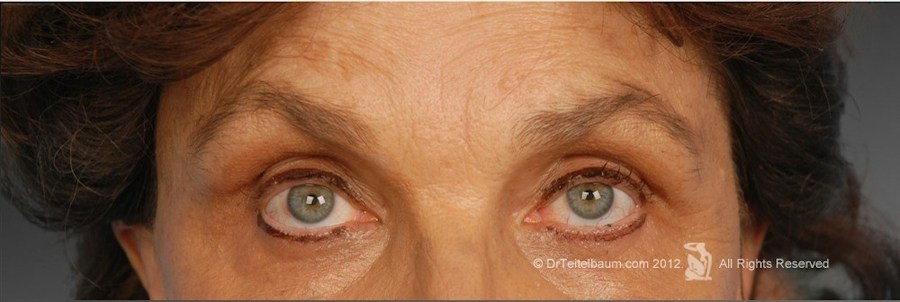 Patient 106009322 | Front View | After | Brow Lift — Steven Teitelbaum MD - Santa Monica