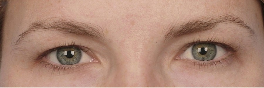 Patient 106009325 | Front View | After | Brow Lift — Steven Teitelbaum MD - Santa Monica