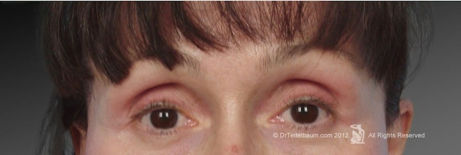 Patient 106009327 | Front View | After | Brow Lift — Steven Teitelbaum MD - Santa Monica