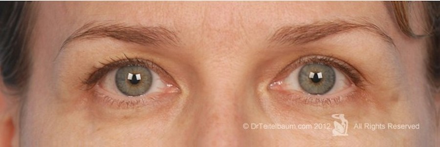 Patient 106009330 | Front View | After | Brow Lift — Steven Teitelbaum MD - Santa Monica