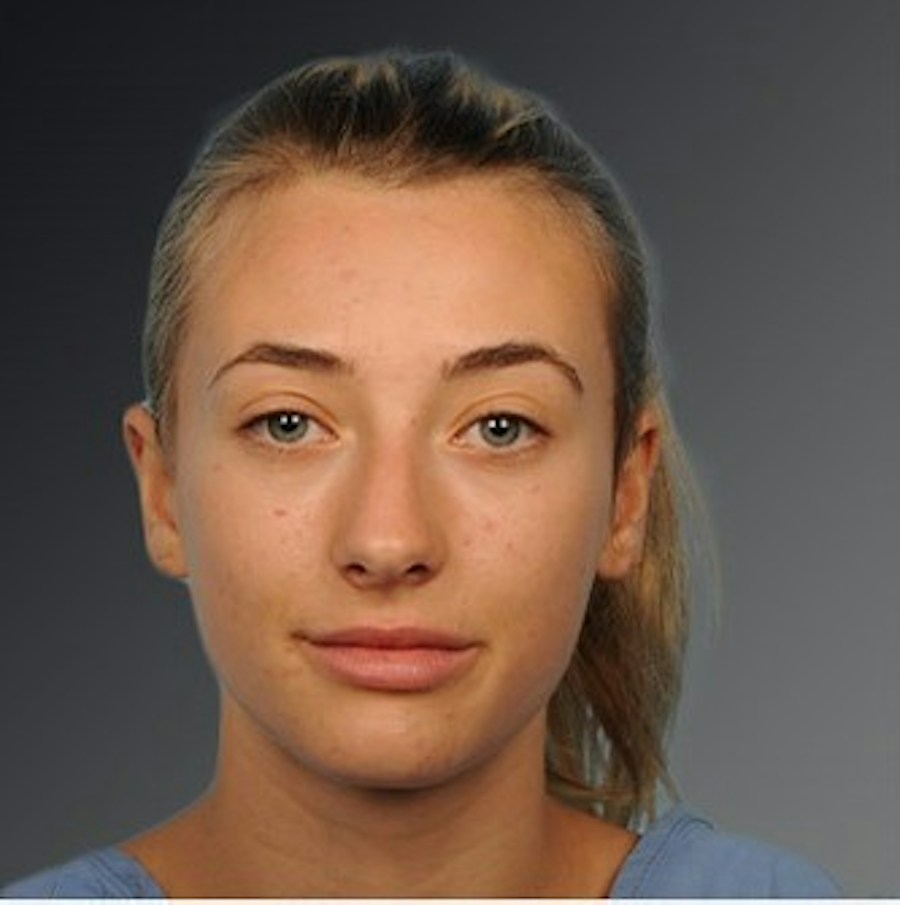 Patient 106009290 | Front View | Before | Rhinoplasty — Steven Teitelbaum MD -