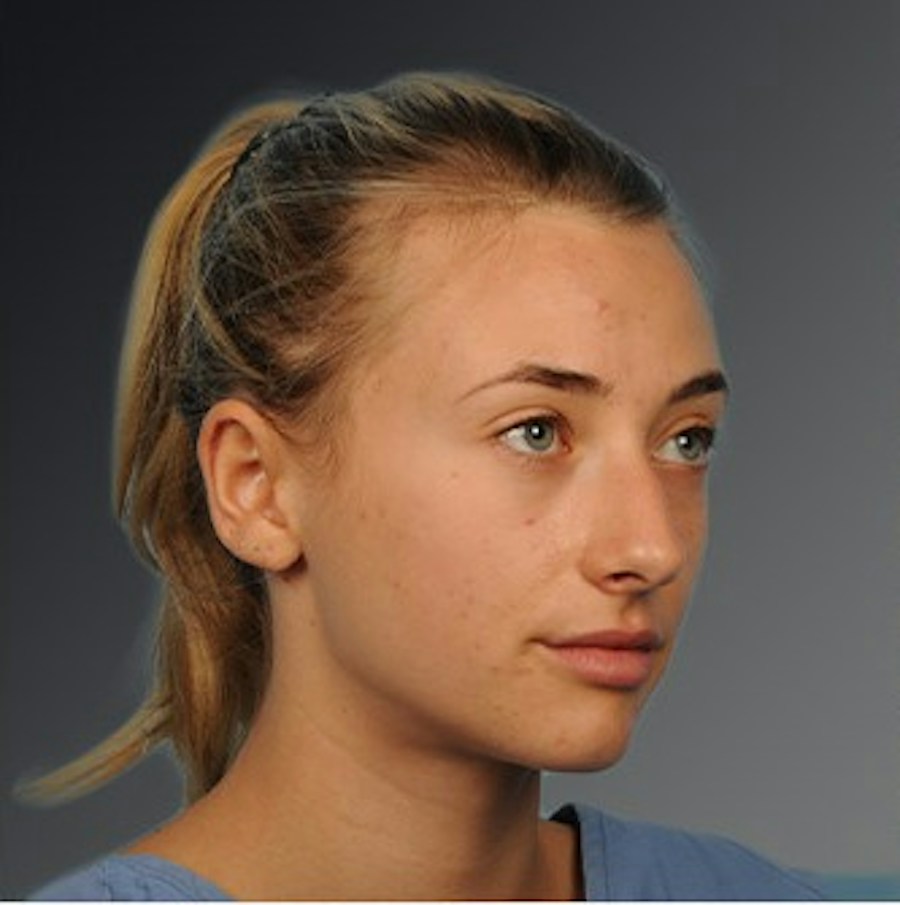 Patient 106009290 | Angle View | Before | Rhinoplasty — Steven Teitelbaum MD -