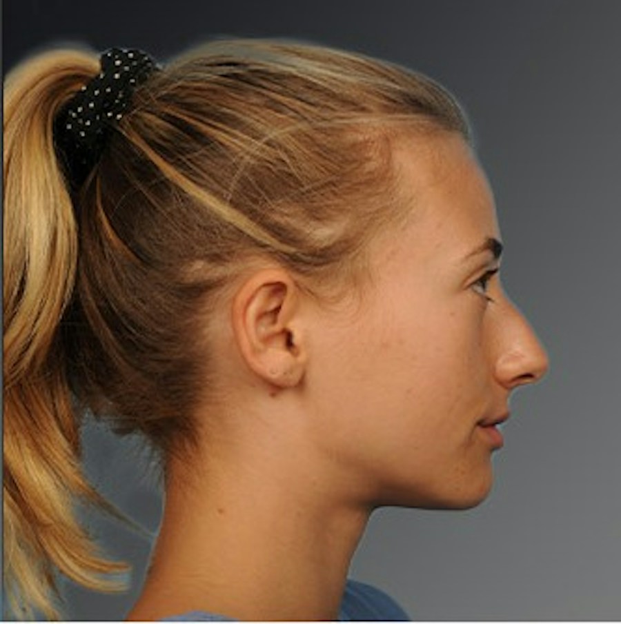 Patient 106009290 | Profile View | Before | Rhinoplasty — Steven Teitelbaum MD -