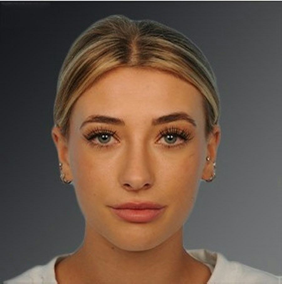 Patient 106009290 | Front View | After | Rhinoplasty — Steven Teitelbaum MD -