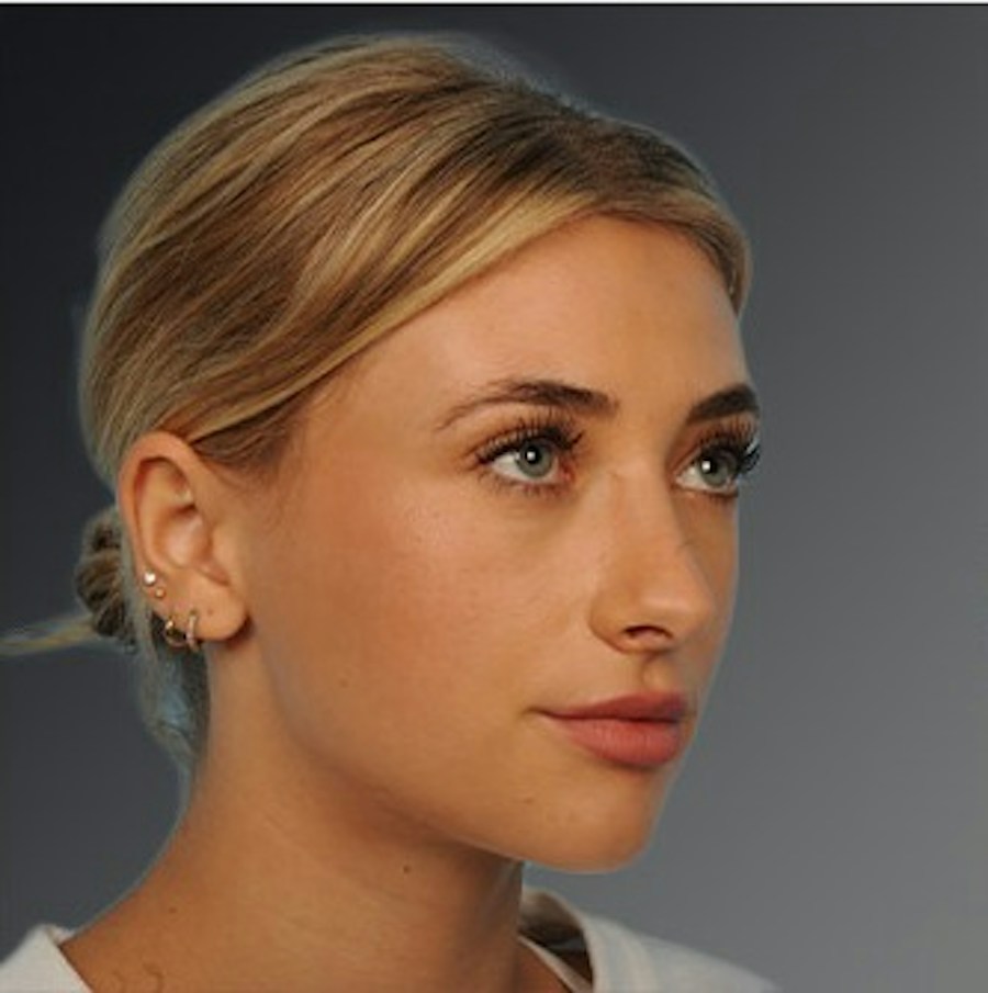 Patient 106009290 | Angle View | After | Rhinoplasty — Steven Teitelbaum MD -