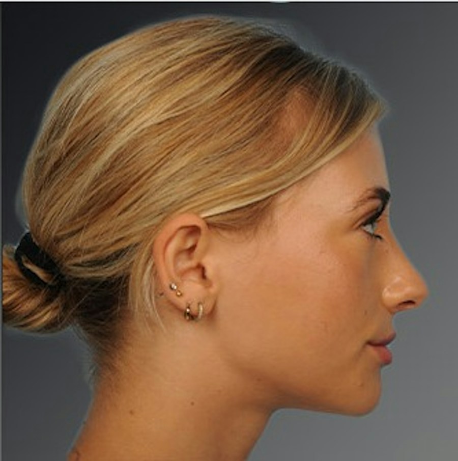Patient 106009290 | Profile View | After | Rhinoplasty — Steven Teitelbaum MD -
