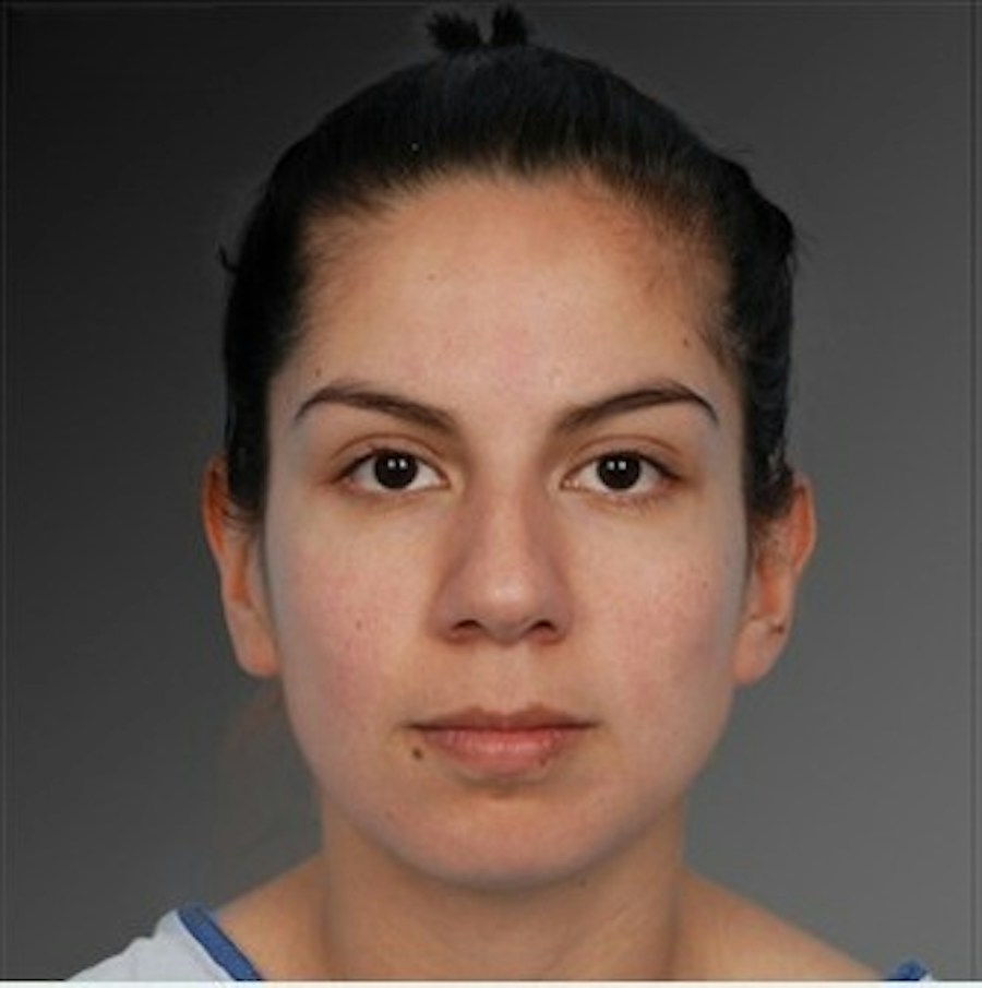 Patient 106009292 | Front View | Before | Rhinoplasty — Steven Teitelbaum MD -