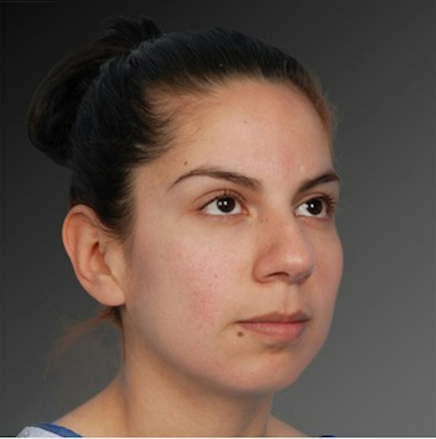 Patient 106009292 | Angle View | Before | Rhinoplasty — Steven Teitelbaum MD -