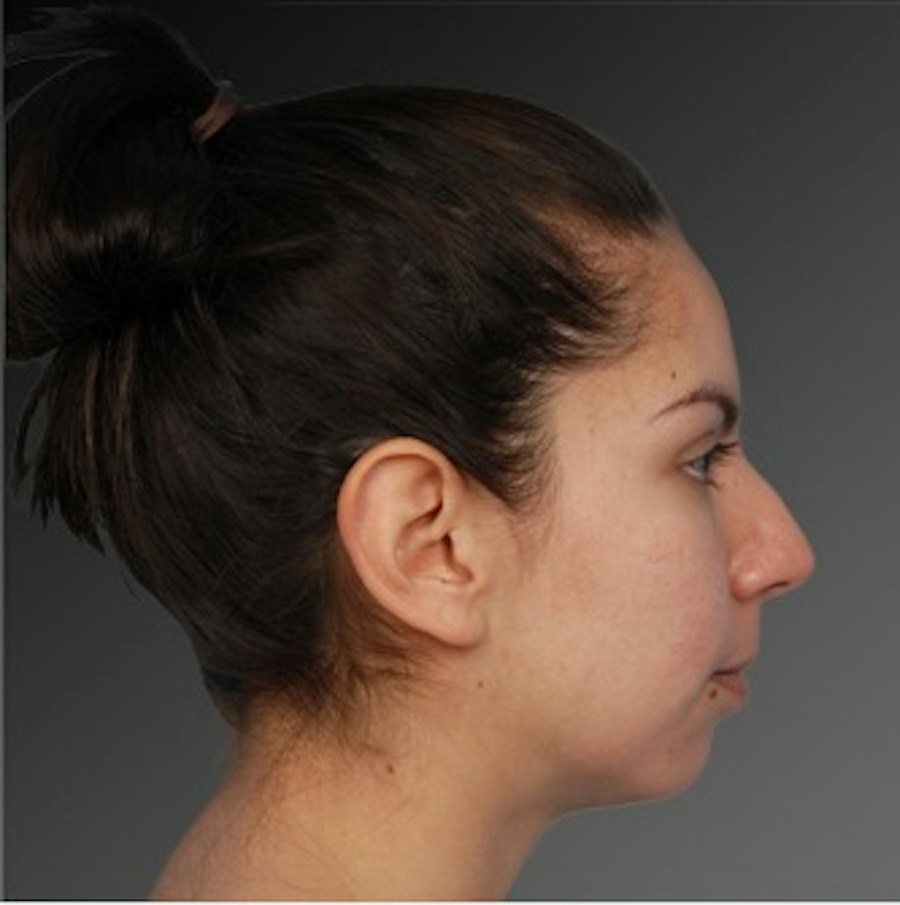 Patient 106009292 | Profile View | Before | Rhinoplasty — Steven Teitelbaum MD -